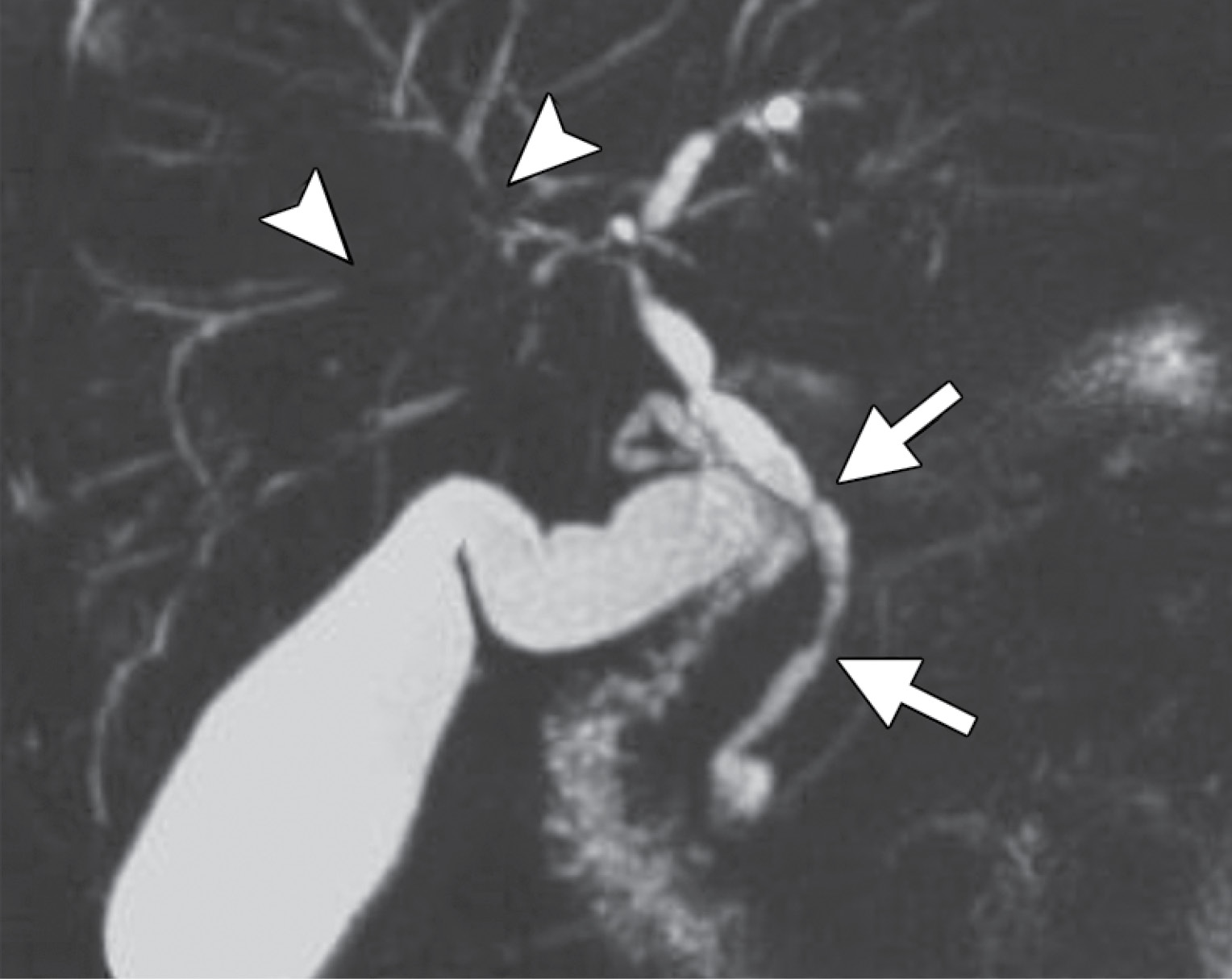 Primary sclerosing cholangitis in a 63-year-old man